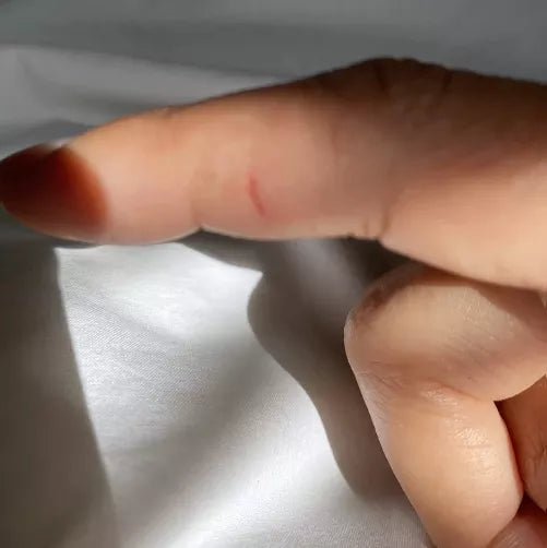 wart treatment results on finger of Elia