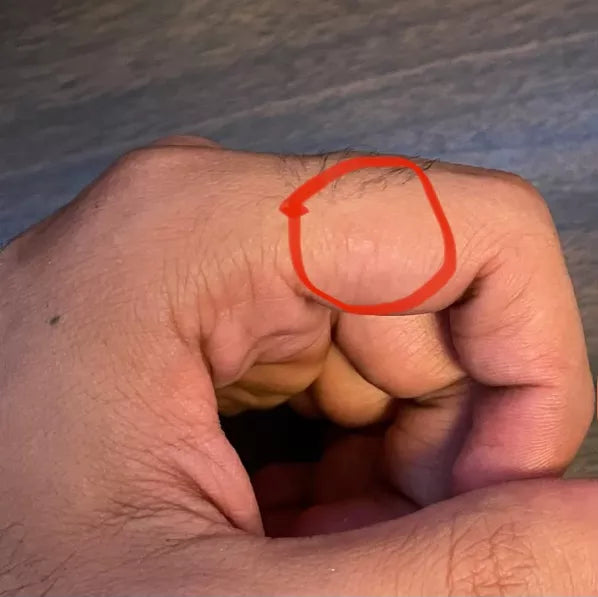 Wart removal treatment worked for Pete